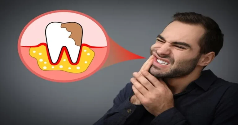 How Long Until Tooth Infection Kills You