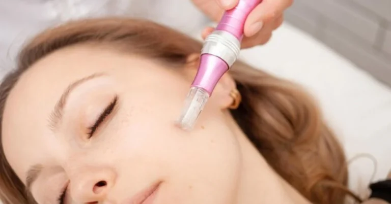 Microneedling